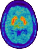 Axial brain image of 18F-DOPA PET showing striatal uptake in both caudate and putamen nuclei